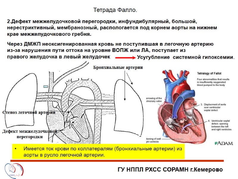 ГУ НППЛ РХСС СОРАМН г.Кемерово Тетрада Фалло. 2.Дефект межжелудочковой перегородки, инфундибулярный, большой, нерестриктивный, мембранозный,